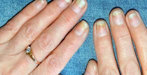 Damaged nails, is it serious?